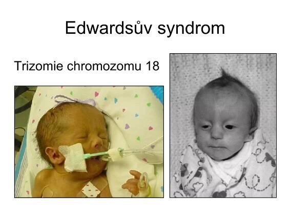 Edwardsův syndrom Trizomie chromozomu 18 