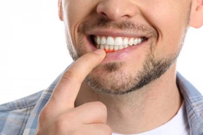 Zánět dásní - Jak dostat hnis z dásně