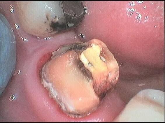Jak často chodit na zubní hygienu, kolik vás to bude stát a komu přispěje pojišťovna