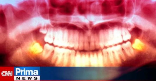 Vědci objasnili záhadu. Proč lidem rostou zuby moudrosti až na prahu dospělosti?