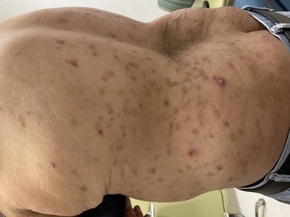 Mezi příznaky lymfomu patří svědění kůže a kožní léze 