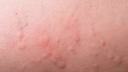 Alergické reakce na tejpy: Co je třeba vědět - GEMMEDICAL s.r.o.