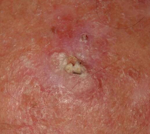 Actinic keratosis (ICD-10: L57) - Online consultation AI dermatologist