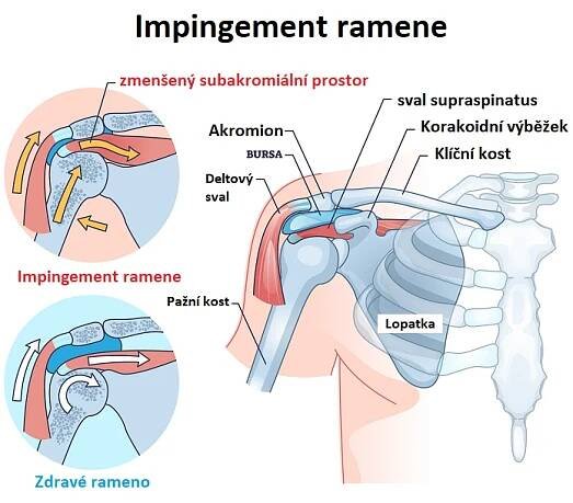 Impingement ramene - ilustrace