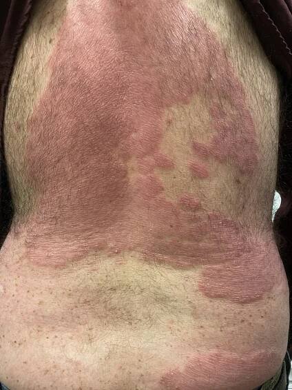 Psoriasis — True Dermatology