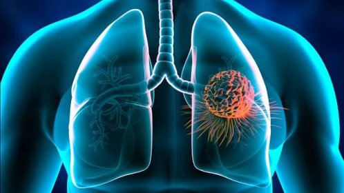 Rakovina plic - čínská medicína, přírodní léčba, bylinky