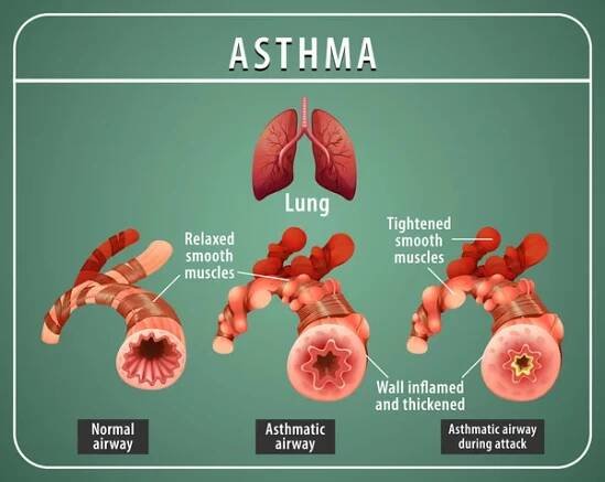 Diagram astmatu s normálními dýchacími cestami a ilustrací astmatických dýchacích cest — Ilustrace