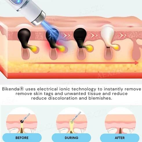 Neinvazivní laserové pero Bikenda® na odstranění znamének a bradavic