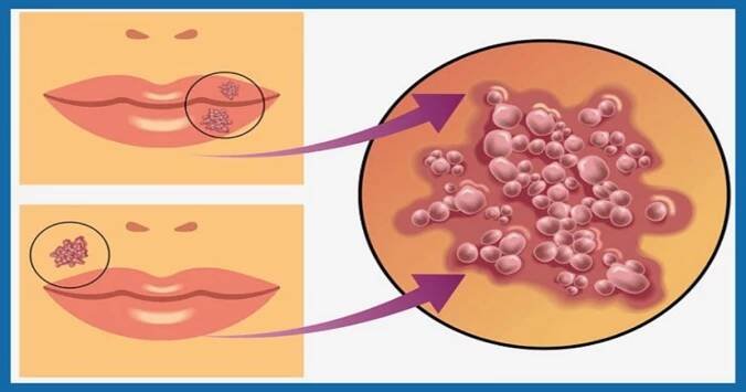 Virus herpes nejčastěji způsobuje vážné zdravotní následky kvůli přehlížení těchto příznaků. Dokáže je rozpoznat i naprostý laik