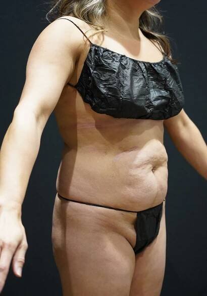 Tummy Tuck - WOW Cosmetic Surgery