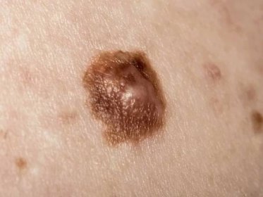 podezřelá mole abnormální barva - melanom - stock snímky, obrázky a fotky