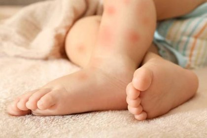 Nohy malého dítěte s červenou vyrážkou — Stock obrázek