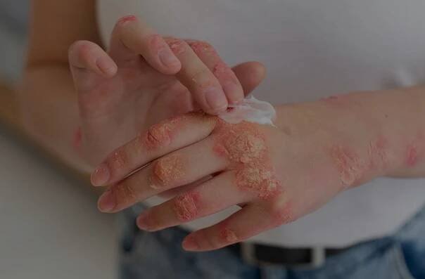 Psoriasis Treatment - Saigram Ayurveda Hospital and Research Institute, Coimbatore