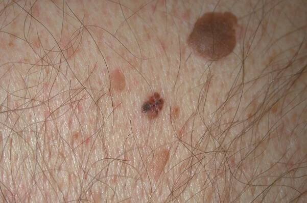 Comparative Study of Dermatoscopes