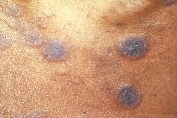 Secondary syphilis rash on skin of color