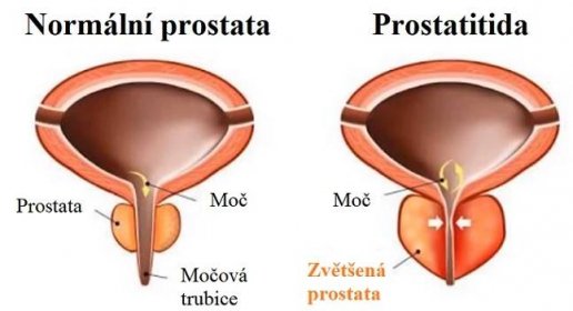 Zdravá prostata vs. prostatitida
