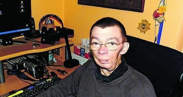 Michael Hofbauer s rakovinou statečně bojoval, i když mu znetvořila tvář