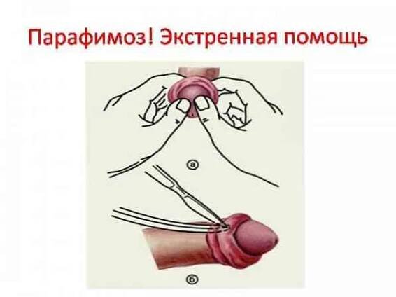 Parafimóza - symptomy, diagnostika, léčba a preventivní opatření / Andrologie | Užitečné informace a tipy na péči o sebe