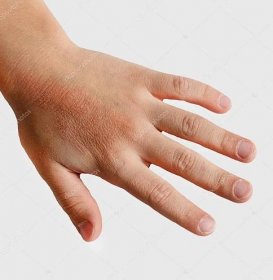 Červené skvrny na kůži rukou dítě pokryté krém. Příčinou je zimní chladné a větrné podmínky. Světle šedé pozadí. — Stock obrázek