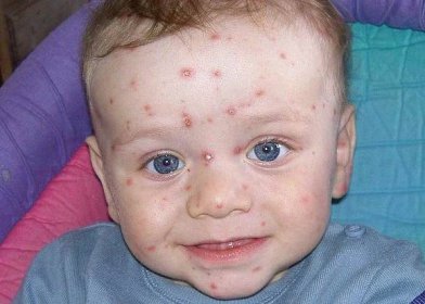Plané neštovice: Snad jediná nemoc, u které si přejete, aby jí dítě chytilo co nejdříve