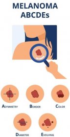 příznaky melanomu abcdes - melanom stock ilustrace