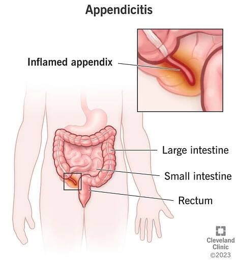 Inflamed appendix, a finger-like organ extending from your large intestine.