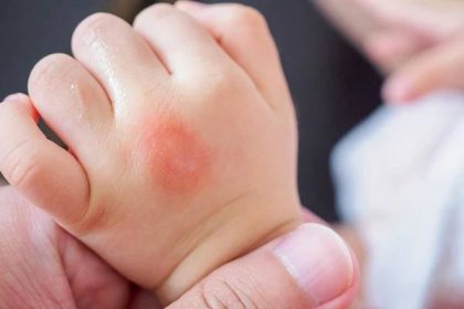 dětská ruka s kožní vyrážkou a alergií s červenou skvrnou příčinou kousnutí komárem - kopřivka - stock snímky, obrázky a fotky