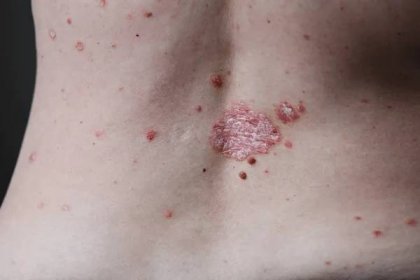Ekzém atopická dermatitida příznak kůže textury. Zblízka kůže s červenými skvrnami — Stock obrázek