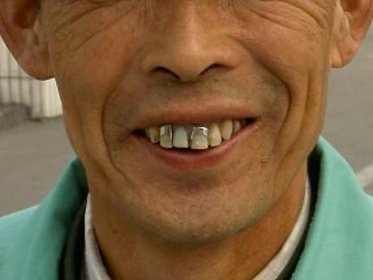 Zkažené zuby