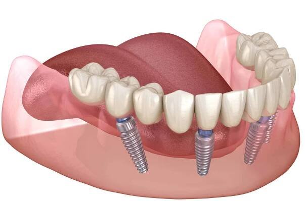mandibulární protéza vše na 4 systému podporované implantáty. lékařsky přesná 3d ilustrace lidského konceptu zubů a zubních protép - edentulous - stock snímky, obrázky a fotky