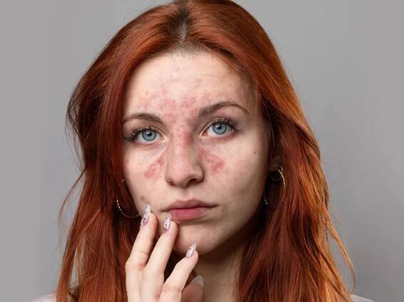 Jak léčit akné, ekzém a další problémy s pletí