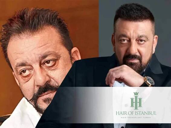 Sanjay Dutt Hair Transplant: A Look at His Transformation