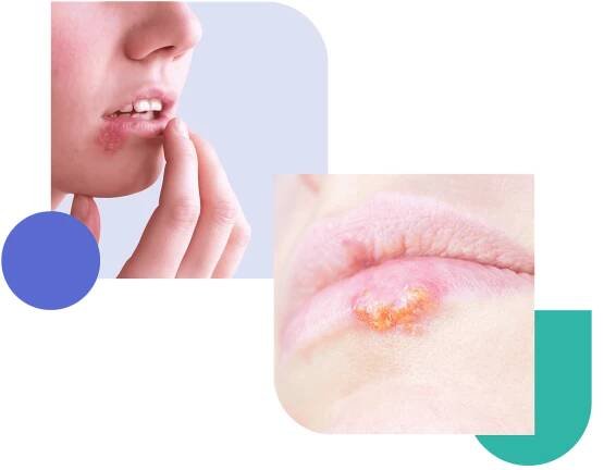 Get herpes treatment online by dermatologist