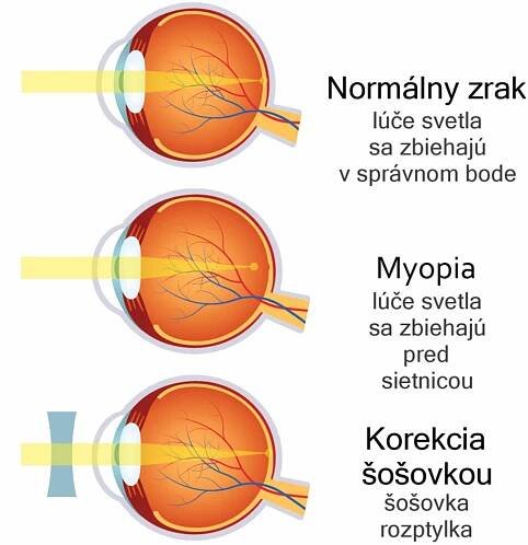 korekcia myopie