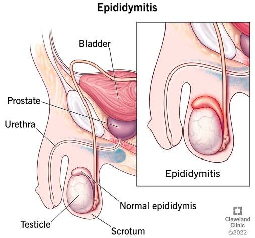 What Is Epididymitis?