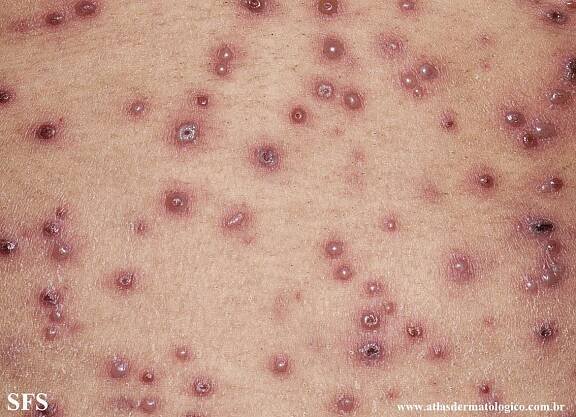 Varicella – NC Commons