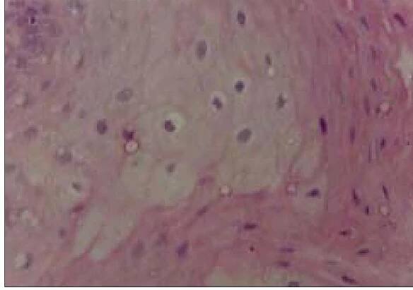 Figure 4: koilocytes, with perinuclear cytoplasmic halos and irregular and hyperchromatic nuclei (H&E, 400x) 