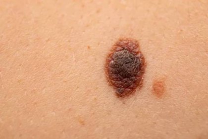 Nebezpečný nevus na kůži-melanom — Stock obrázek