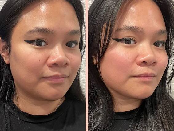 Emface Review With Photos: Is It a Needle-Free Alternative to Botox and Filler?