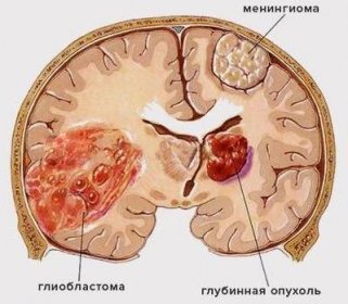 Glioblastom mozku