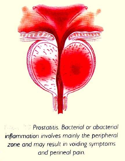 Persistent Prostatitis | Chin Chong Min Urology & Robotic Surgery Centre