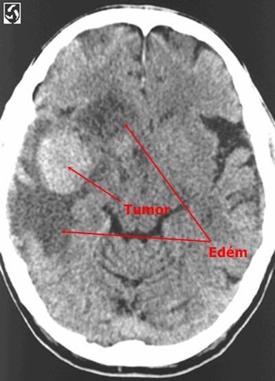 Perifokální edém mozku - CT | Medicína, nemoci, studium na 1. LF UK