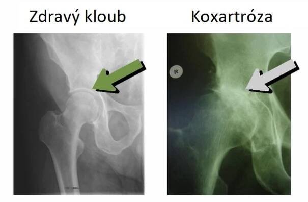 Koxartróza (artróza kyčelního kloubu) – co je to – příčiny, příznaky a léčba