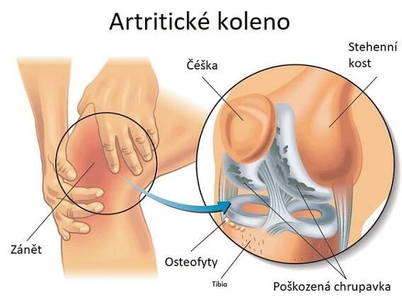 Artritida kloubů – jak na ni – příznaky, příčiny a léčba