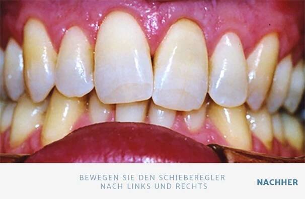 Bleaching