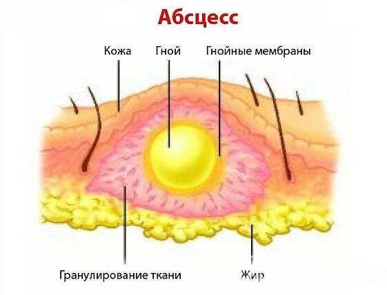 Příčiny a příznaky abscesu / Absces