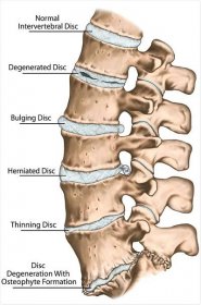 Spine disc problems, degenerative lumbar disc disease, degenerative disc disorder, degenerated disk, bulging disk, herniated disk, thinning disk, disk degeneration with osteophyte formation — Stock obrázek