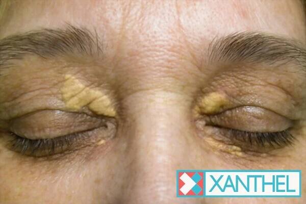 jak vypadá xanthelasma 1