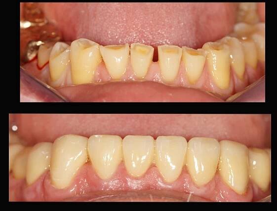 Bleaching Ergebnisse