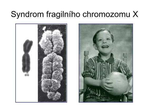 Syndrom fragilního chromozomu X 